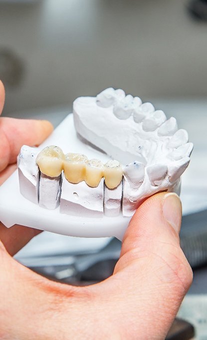 Dental bridge on a mold of a tooth