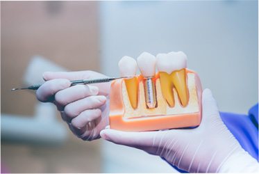 Model of dental implant and crown in Denver