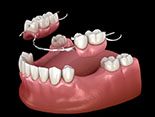partial denture replacing multiple missing teeth