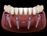 implant denture on the lower arch 