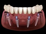 implant denture on the lower arch