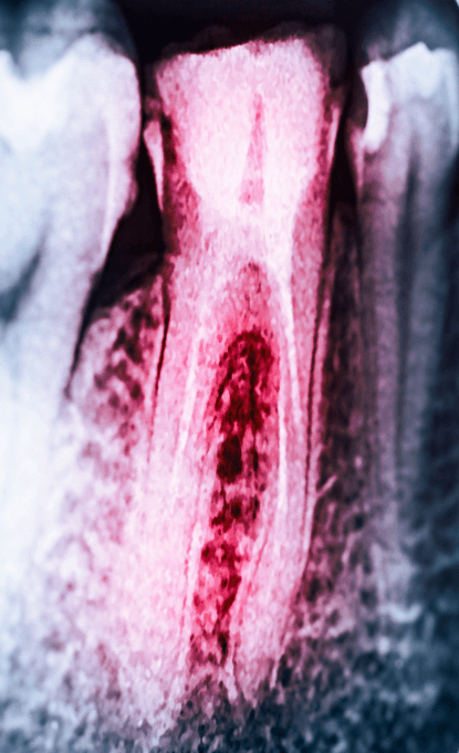X-ray of tooth after root canal therapy