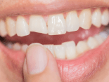 Closeup of smile with chipped front tooth