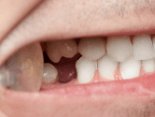 Closeup of smile with knocked out tooth