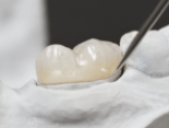 Model smile with dental crown to replace lost dental restoration