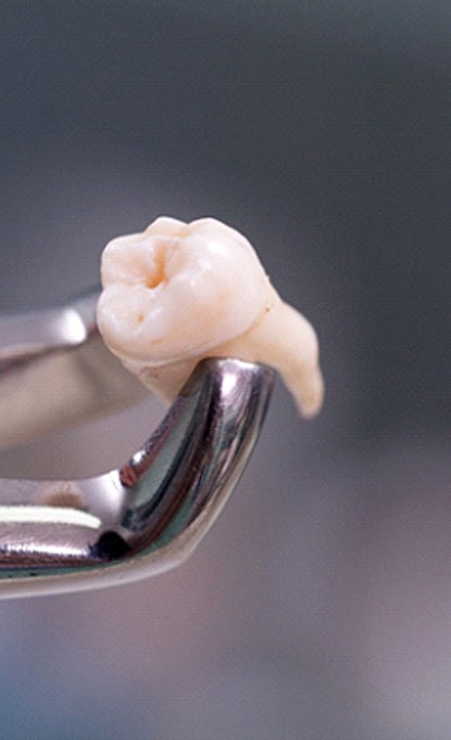 Extracted tooth in Denver being held by forceps