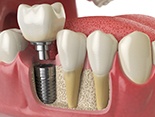 Illustration of crown being attached to dental implant in Denver, CO