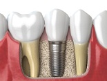 dental implant 3D graphic