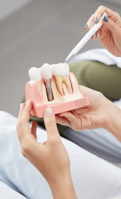 Model dental implant supported repalcement tooth