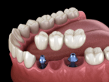 Animated dental implant supported fixed bridge placement