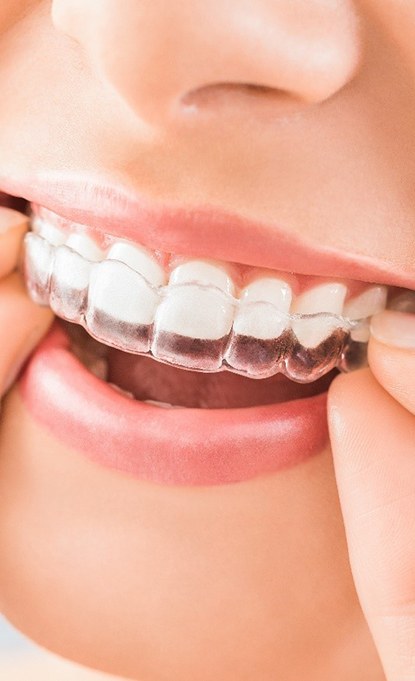 Closeup of patient wearing Invisalign in Sarasota 