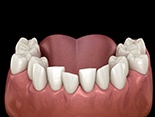 Illustration of crowded teeth