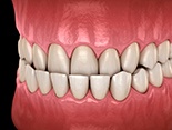 Illustration of underbite