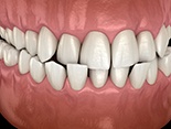 Illustration of crossbite