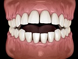 Illustration of open bite