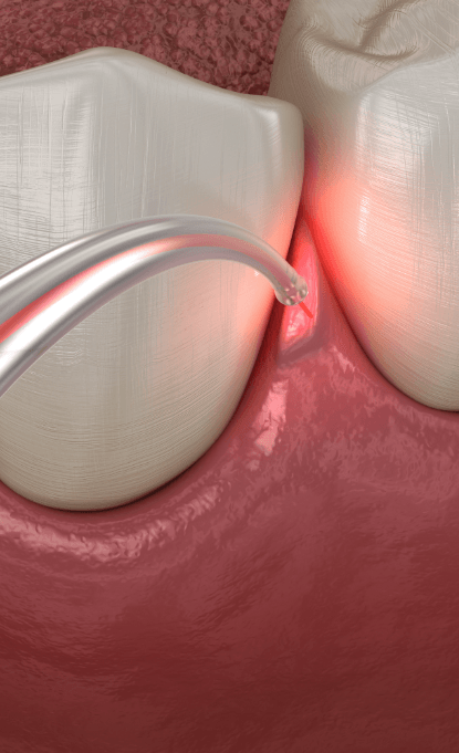 Animated smile receiving laser periodontal therapy