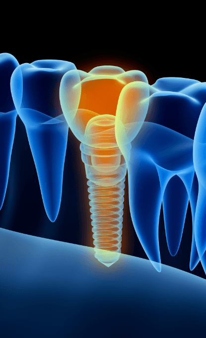 Animated dental implant supported dental crown