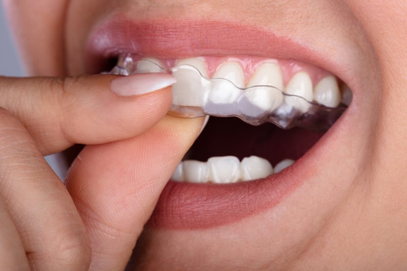 Woman placing clear aligners in her mouth
