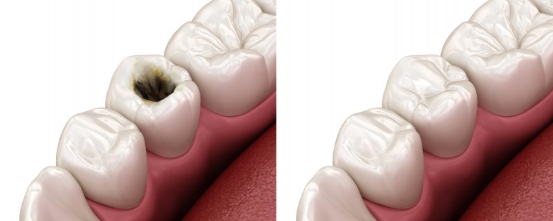 3D rendering of a before and after of cavity treatment