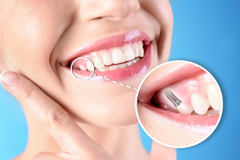 Nose-to-neck of woman smiling with one tooth indicated as an implant